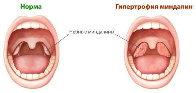Чи потрібно видаляти аденоїди і гланди у дорослої людини?