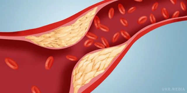 Названі прості способи для зменшення холестеринових бляшок